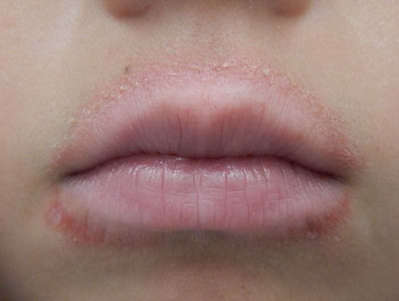 Liplik eczeem symptomen: ontstoken lippen & schilferende lip